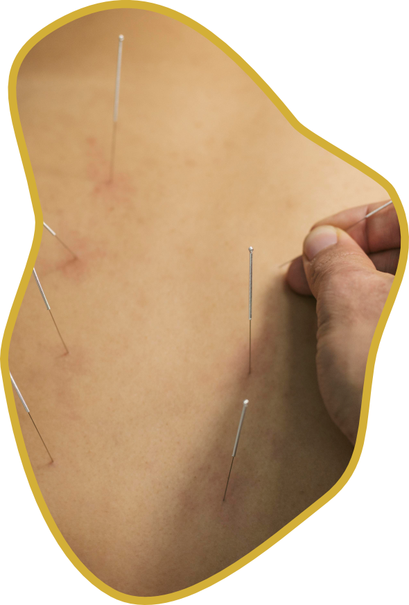 Quando a acupuntura e indicada