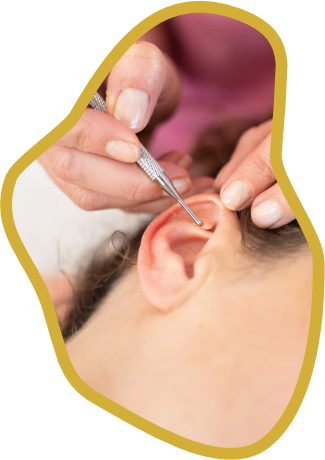 Auriculoterapia